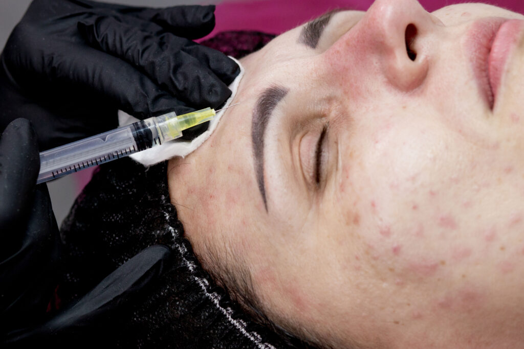 Acne Scar Treatment With Prp Lifeboost Boca Raton