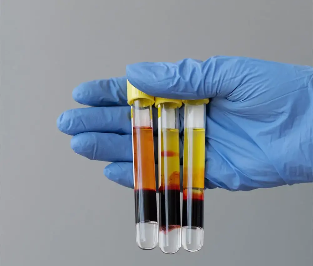 PRP-injections PRP-injections