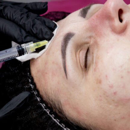 Cosmetologist doctor is making multiple injections biorevitalization with hyaluronic acid in woman face skin, closeup. Woman on the procedure of mesotherapy injection.
