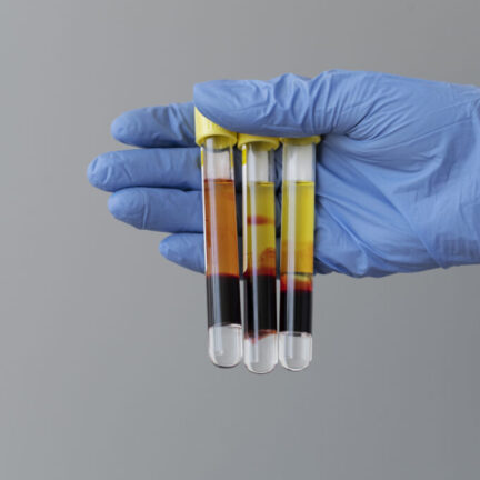hand-with-glove-holding-vials-prp-treatment-681x1024
