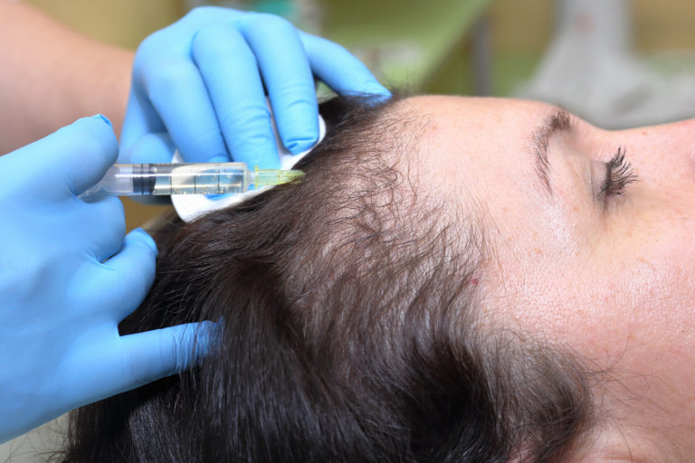 PRP for Hair Restoration